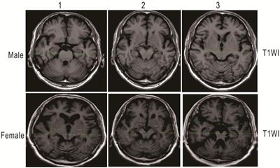 Better Screening Value of Sylvian Fissure Ratio on Cognitive Decline Among Female Compared to Male: An Observational Study in Elderly Patients With Cerebral Small Vessel Disease in Soochow